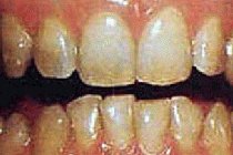 Laser Bleaching