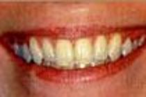 Brite Smile whitening