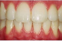Customfit Tray Bleaching