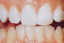 Laser Bleaching