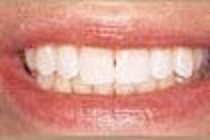 Instant Orthodontics