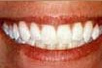 Brite Smile whitening