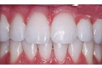 Customfit Tray Bleaching